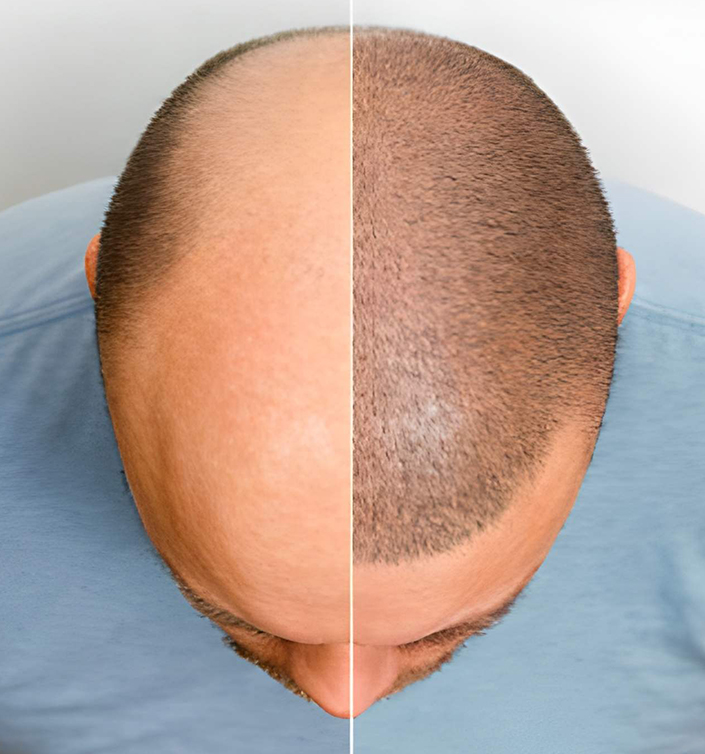 ZR Hair Transplant