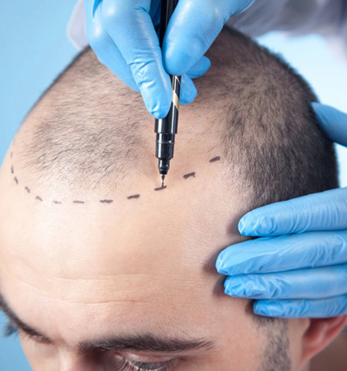 FUE Saç Ekimi